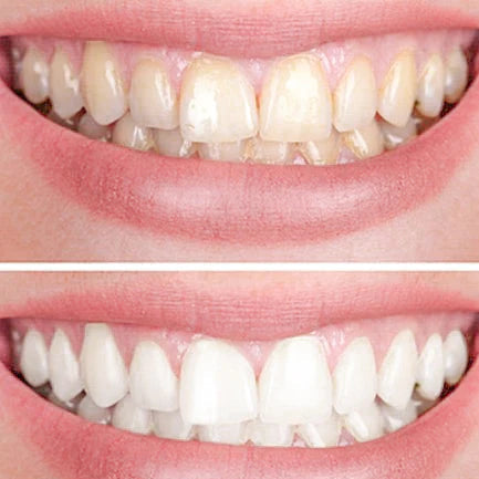 Smiley Teeth Whitening (Promotion)