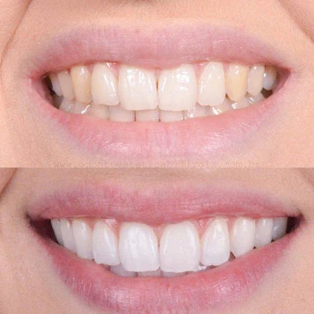 Smiley Teeth Whitening (Promotion)
