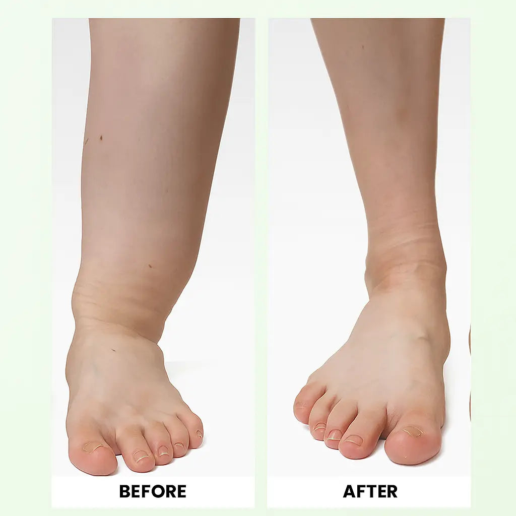 OrthoMax® Lymphatic - Therapeutic Device for Lymphoedema and Water Retention