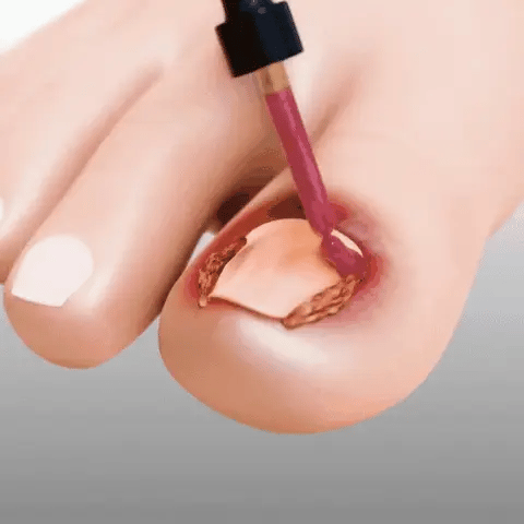 FungiClear™ – Nail Repair Serum